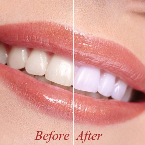 Trends in Teeth Whitening Products